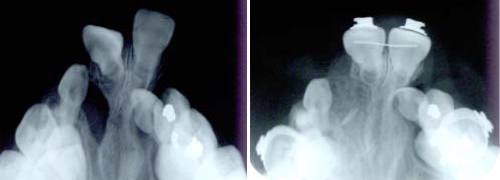顎裂部骨移植（骨移植後のＸ線所見）